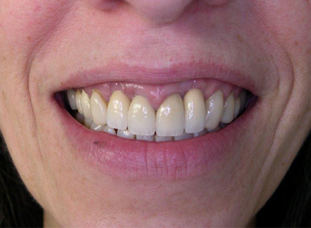 Prothèse tout Céramique sur implant et dent naturelle Après