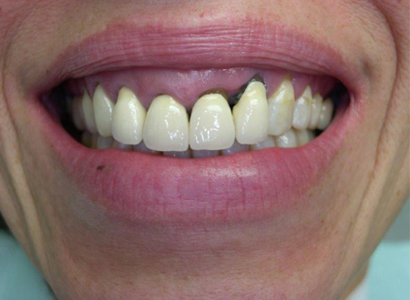 Prothèse tout Céramique sur implant et dent naturelle Avant