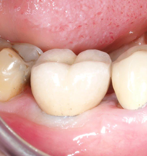 Remplacer une dent cas cliniques