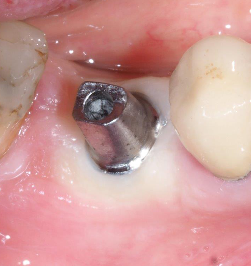 Remplacer une dent cas cliniques